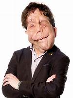 Exploring Adam Pearson's Relationships: a Journey Through Love and Connection