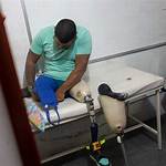 Mason Leg Amputated Surgery: Understanding the Procedure and Recovery