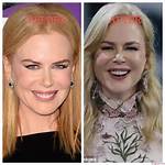 Nicole Kidman and Botox: the Truth Behind Her Ageless Beauty