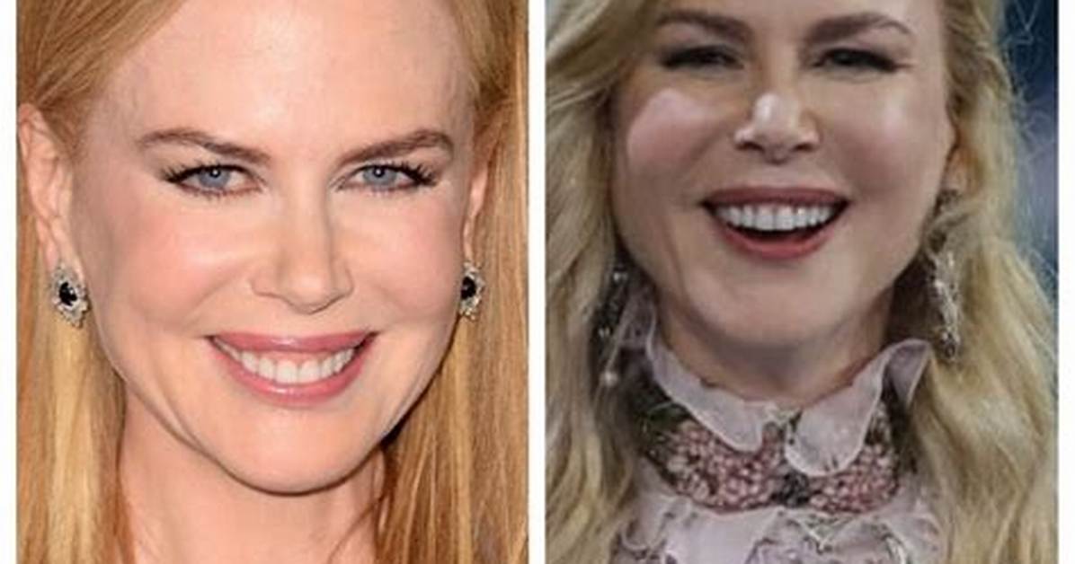 Nicole Kidman Procedures: a Comprehensive Look at Her Beauty Transformations